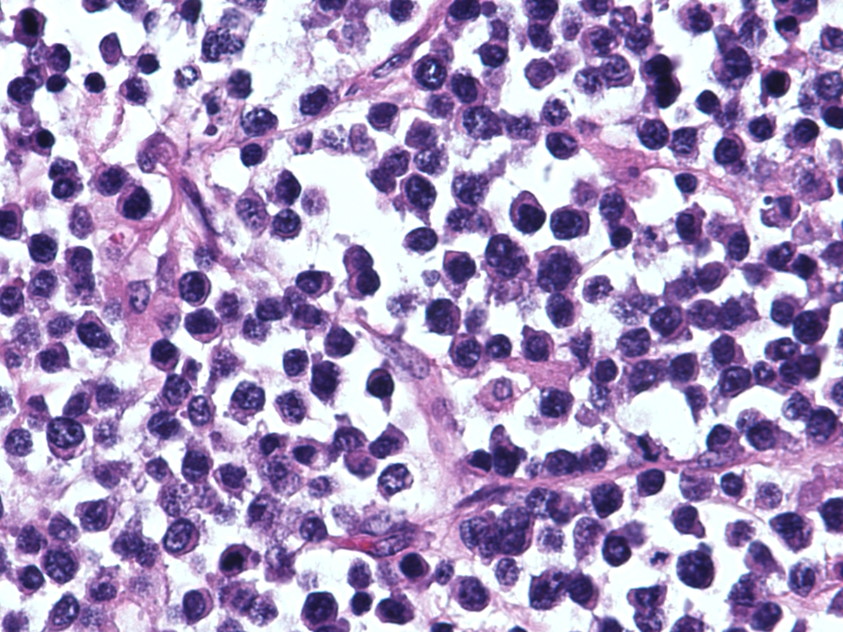 Retroperitoneal mass, high power